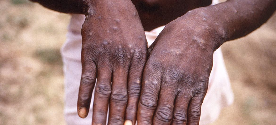 Minimal risk of monkeypox transmission in UK following confirmed case | | UN News